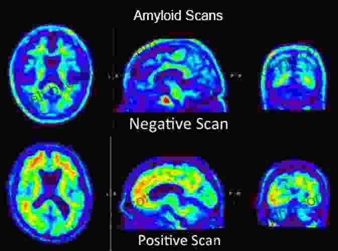 A Brain Scan Showing Amyloid Plaques, A Hallmark Of Alzheimer's Disease. Decoding Darkness: The Search For The Genetic Causes Of Alzheimer S Disease
